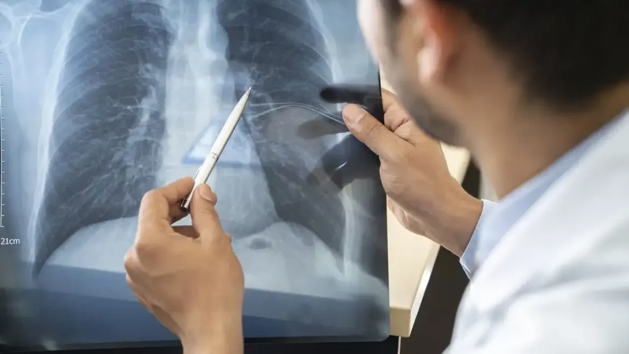 estagios-cancer-de-pulmao