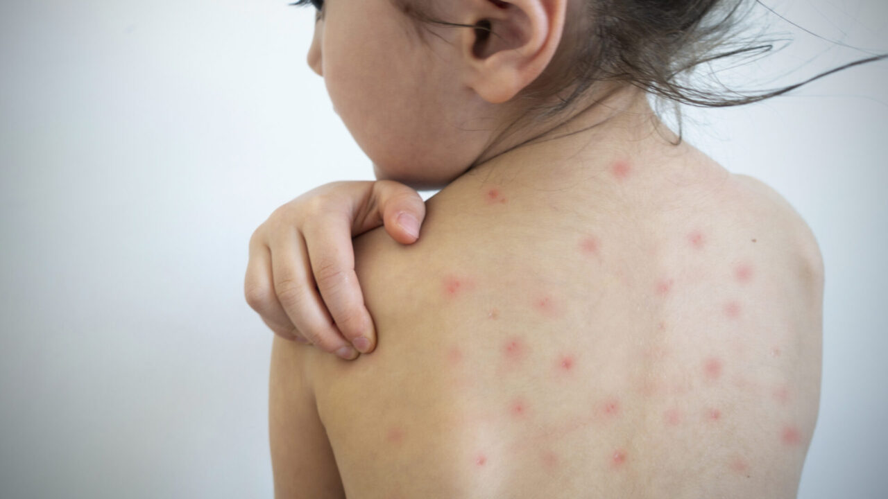 Young girl with measles virus.